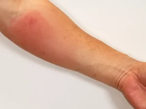 ハチに刺された腕